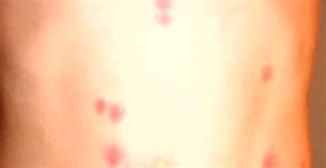 Bed Bug Bites Pictures Symptoms Causes Treatment Hubpages