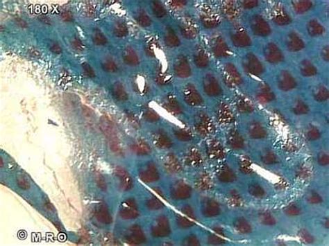 Morgellons disease is a controversial, unexplained skin condition. Morgellons microscopic pictures of unknown microscopic objects