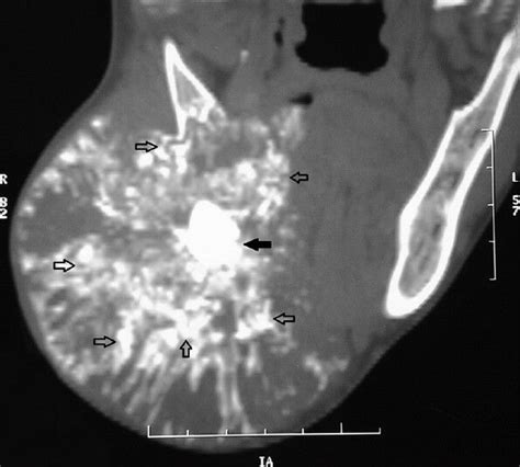 Giant Pindborg Tumor Calcifying Epithelial Odontogenic Tumor An