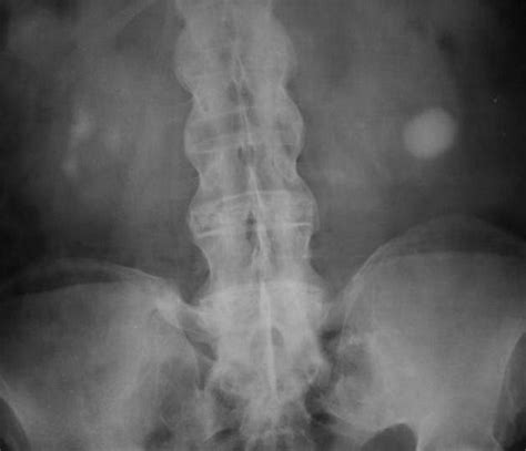 Ankylosing Spondylitis Radiology Case Ankylosing