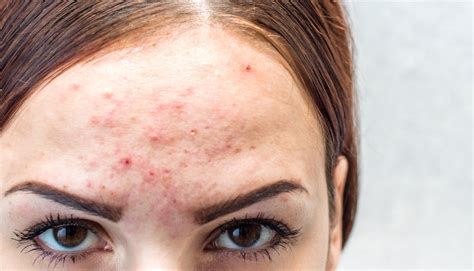 Acne Treatment Solutions For Even The Worst Acne Cases