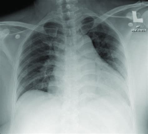 Portable Chest X Ray Showing Cardiomegaly And Bilateral Plethoric Lung