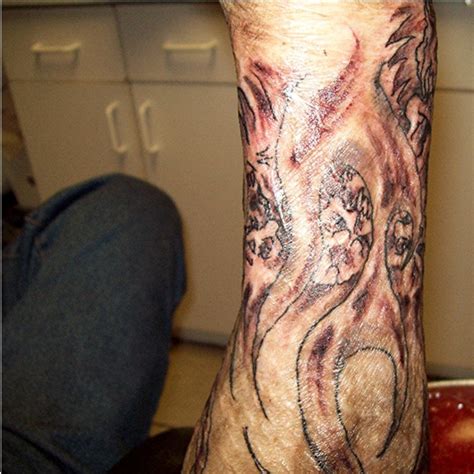 Tattoos On Burn Scars Tatring