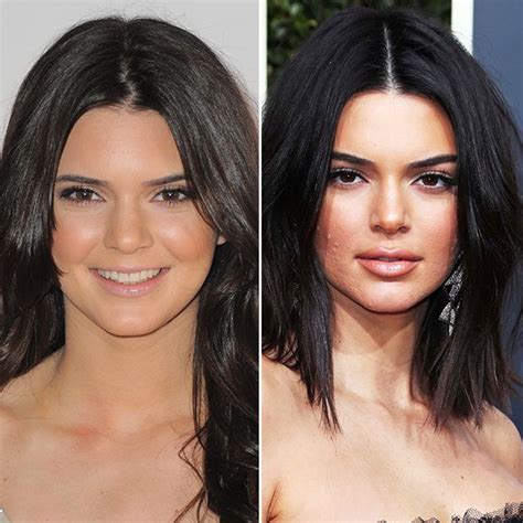 kendall jenner lip filler debate buzzpopdaily