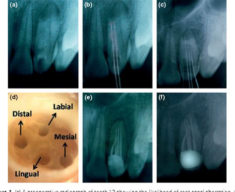 PDF A Maxillary Lateral Incisor With Four Root Canals Semantic Scholar