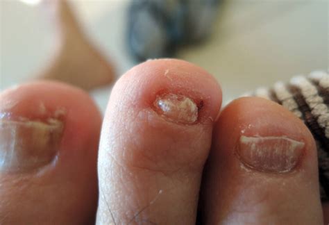 Onychomycosis Also Known As Tinea Unguium Is Free Stock Photo And Image