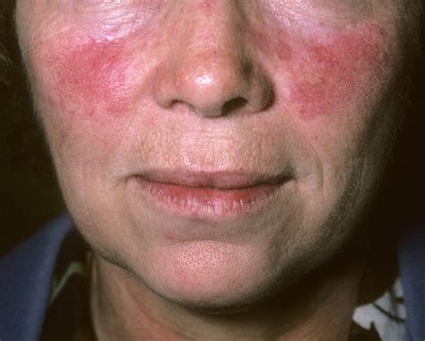 Ivermectin can be applied topically and also has an oral form, which is commonly used to treat mange in animals. Topical Ivermectin Most Effective, Improves QoL in ...