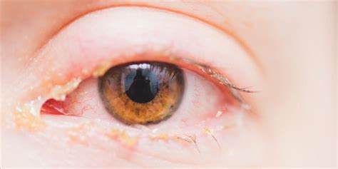 What Causes Discharge From Eyes Pristyn Care