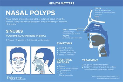 Nasal Polyps Symptoms Causes And Natural Support Strategies