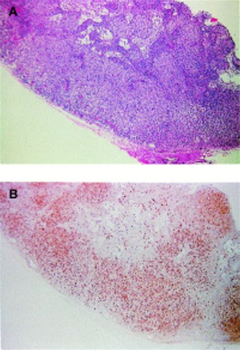 Diagnosis Of Severe Combined Immunodeficiency Journal Of Clinical