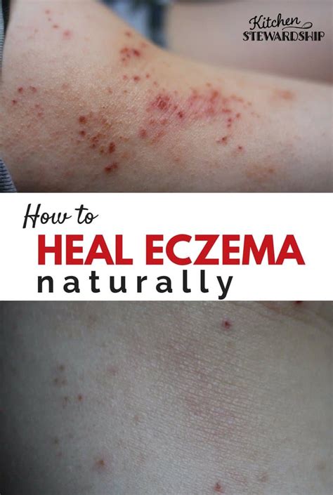 Stop The Itch Identify Triggers And Treat Eczema Naturally