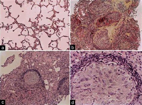 A D Histopathology Of The Hilar Lymph Nodes On Transbronchial Biopsy