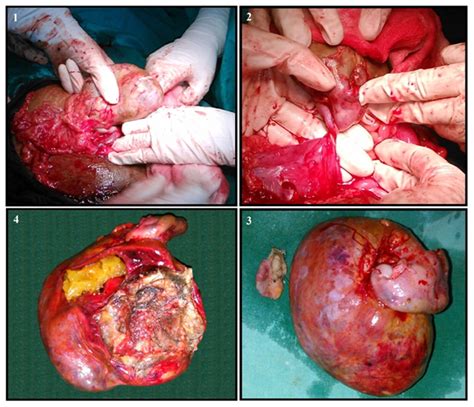 Subtle Presentation Of Bilateral Ovarian Dermoid Cysts With Unilateral