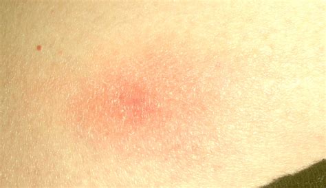 Mycosis Fungoides Pictures Treatment Symptoms Causes