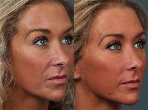 Laser Genesis Treatment Before And After Photo Gallery Louisville