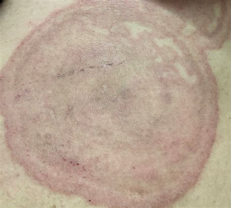 Steroid Creams Can Make Ringworm Worse Fungal Diseases Cdc