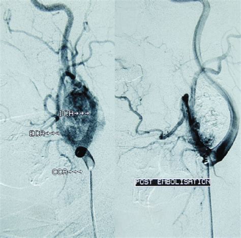 Digital Substraction Angiography Before Left And After Embolization