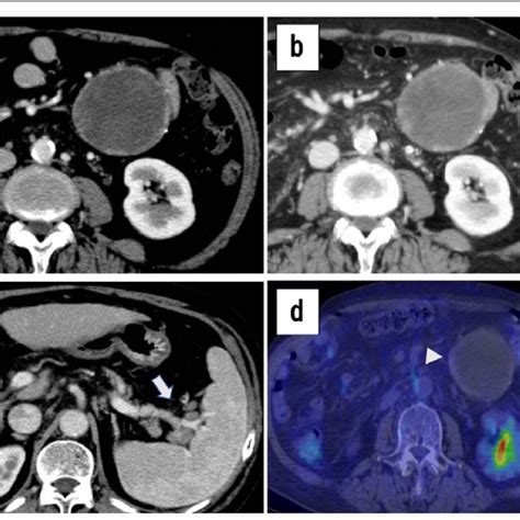 Abdominal Contrast Enhanced Computed Tomography Ct Findings A C A