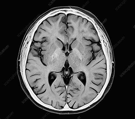 Basal Ganglia Human Brain