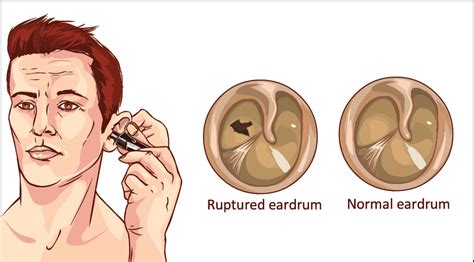Ruptured Ear Drum Symptoms