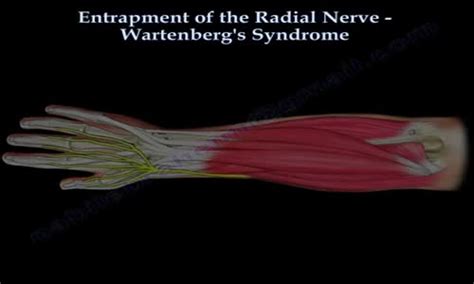 Entrapment Of Radial Nerve Wartenbergs Syndrome Everything You Need To