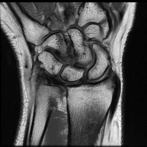 Ulnar Impaction Syndrome Bone And Spine