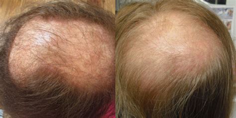 Permanent Female Hair Loss Living With Hair Loss