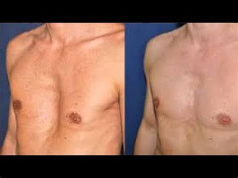 How To Get Rid Of Pectus Excavatum Without Surgery Fast YouTube