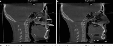 Figure 2 From How Does Bimaxillary Orthognathic Surgery Change