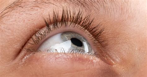 Understanding Corneal Ulcer Healing Stages