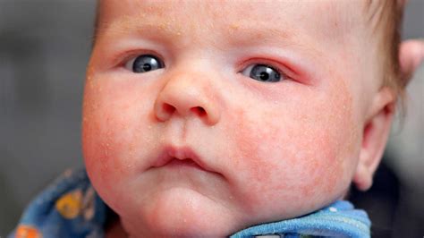 How Environmental Factors Impact Infantile Eczema Eczema Kids Eczema