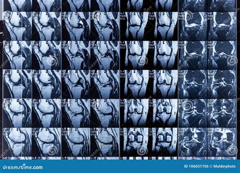Magnetic Resonance Imaging Mri Of Human Knee Joint For Medical