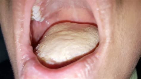 Thick White Tongue Very Severe Oral Thrush Oral Candidiasis In Young