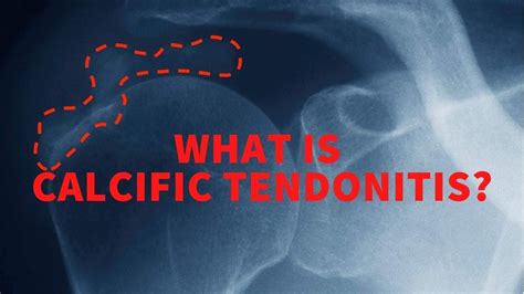 What Is Calcific Tendonitis YouTube