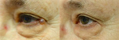 Eyelid Growth Removal Archives In Focus Ophthalmic Plastic Surgery