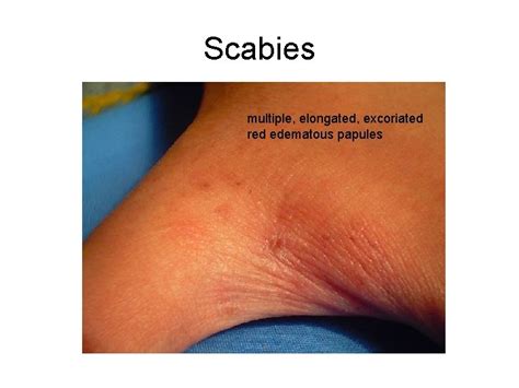 Common Pediatrics Rashes Primary Skin Lesions Primary Skin