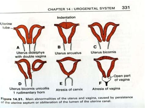 Considered to be sporadic, it is a rare congenital disorder of the female reproductive system depicted by the absence of. Mullerian anomalies