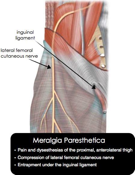 Meralgia Paresthetica Pain Or Dysesthesias Or Both In The