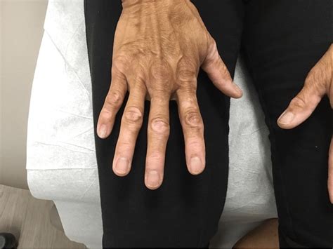 Multiple Depigmented Patches Located On The Bilateral Dorsal Hands
