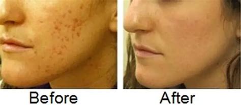 How To Fade Acne Scars Fast Naturally Diminish Acne Marks