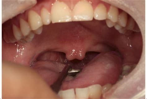 What Does A Bifid Uvula Indicate