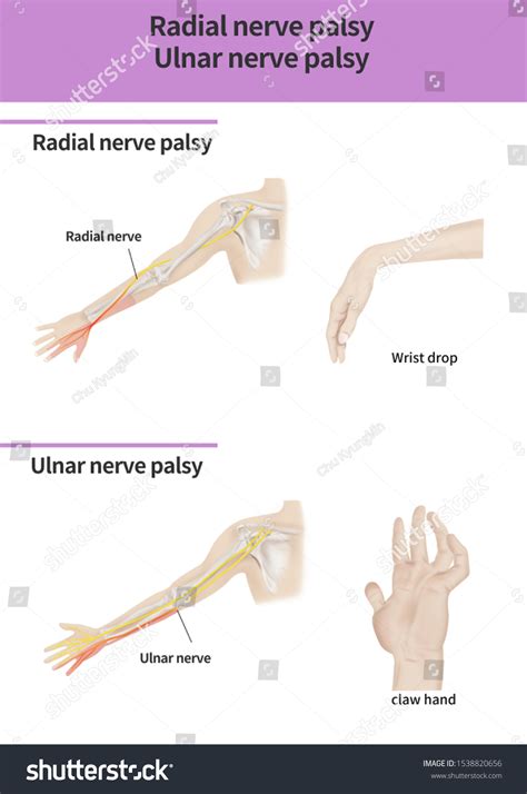 Radial Nerve Palsy Ulnar Nerve Palsy 库存插图 1538820656 Shutterstock