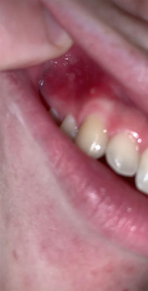 Red Gums On Only One Side Of My Mouth A Little White Dot U Can See It