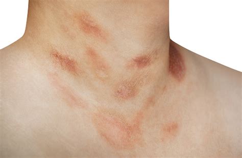 One Person With Pityriasis Rosea Disease On The Chest And Neck Stock