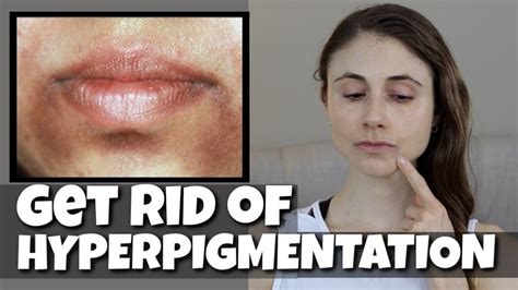 Get Rid Of Hyperpigmentation Around The Mouth Dr Dray