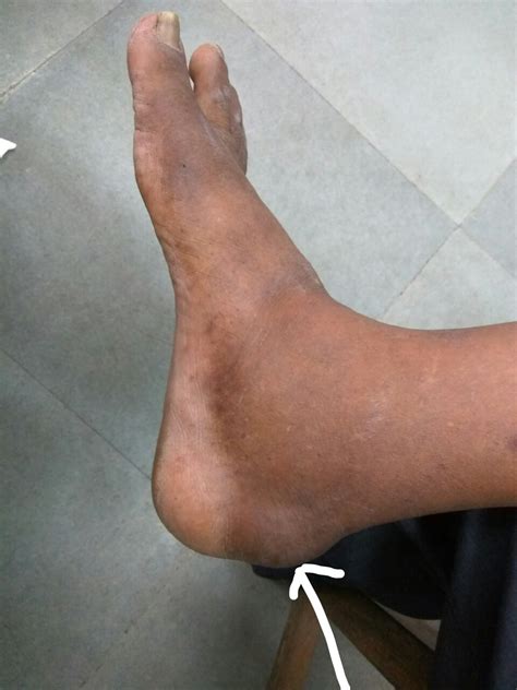 A 60 Year Old Male Patient With Swelling And Pain Over Posterior Aspect