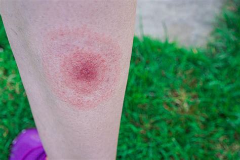6000 Erythema Migrans Stock Photos Pictures And Royalty Free Images