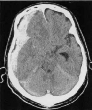 Acute Subdural Hematoma Axial Non Enhanced Ct In A Head Injured