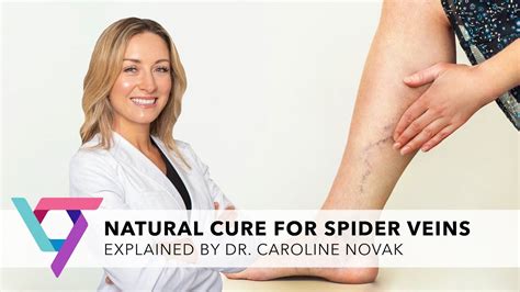 Medical Center Natural Cure For Varicose Veins Top Vein Expert New