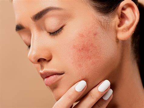 How To Repair Damaged Skin In 10 Days